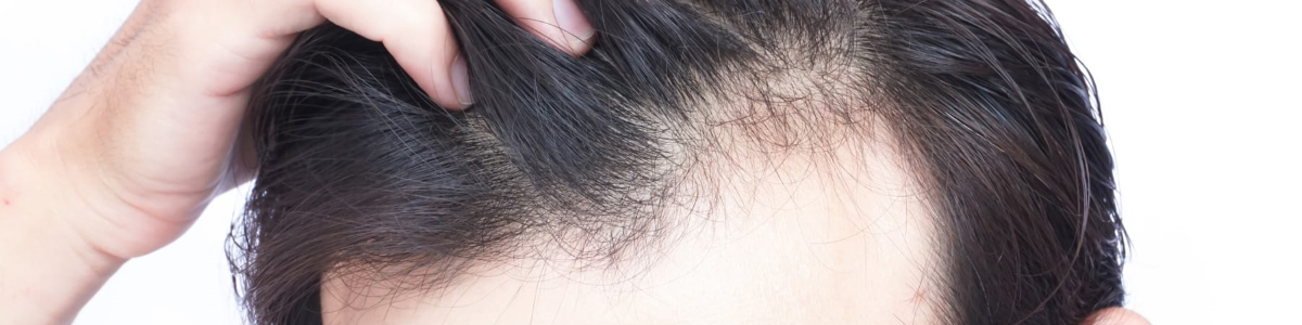 Hair Loss: What is hair loss Causes Types Symptoms Diagnosis Treatment